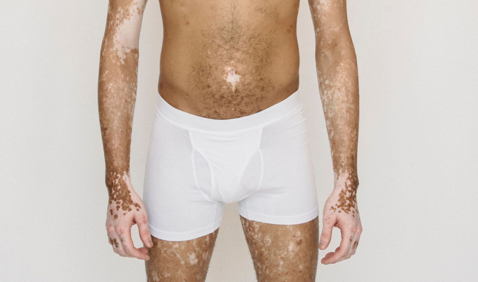 A trans person with vitiligo confidently posing in boxers